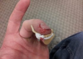 “I only had to put on a band-aid.”