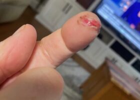 Harv Weiler Finger Save